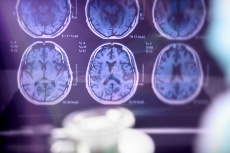 Brain scans highlighting early signs of Alzheimer's disease, showcasing multiple MRI images with anatomical labels for analysis in senior health contexts.